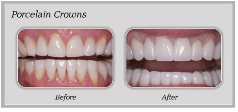 Crowns - Before and After