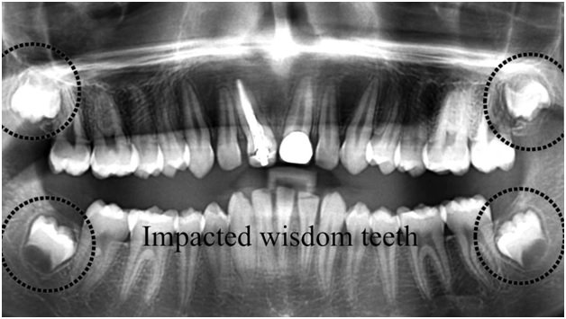 Wisdom Teeth Surgery