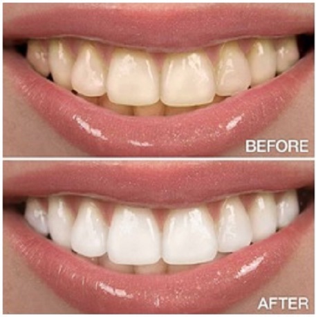 Shades of Teeth before and after